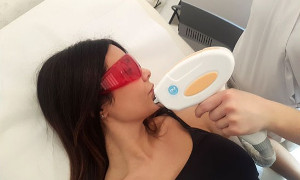 Quanto dura l'epilazione laser