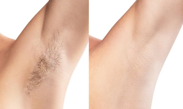 Epilazione laser e ormoni